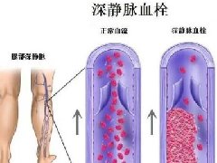 【健康科普】血管里的隐形杀手——静脉血栓