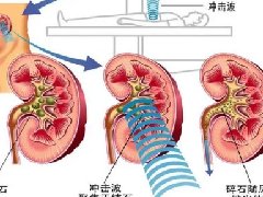 【特色诊疗技术】结石“消消乐”——泌尿系统结石的微创治疗