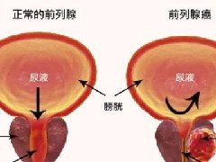 【健康科普】男性最常见的恶性肿瘤之前列腺癌