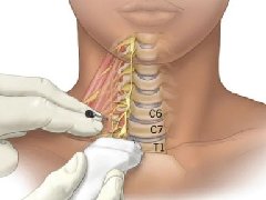 【作风卫健】解锁睡眠问题新技术：星状神经节阻滞疗法带你告别失眠困扰