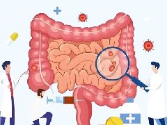 【健康科普】胃肠道里的“小蘑菇”：认识胃肠息肉
